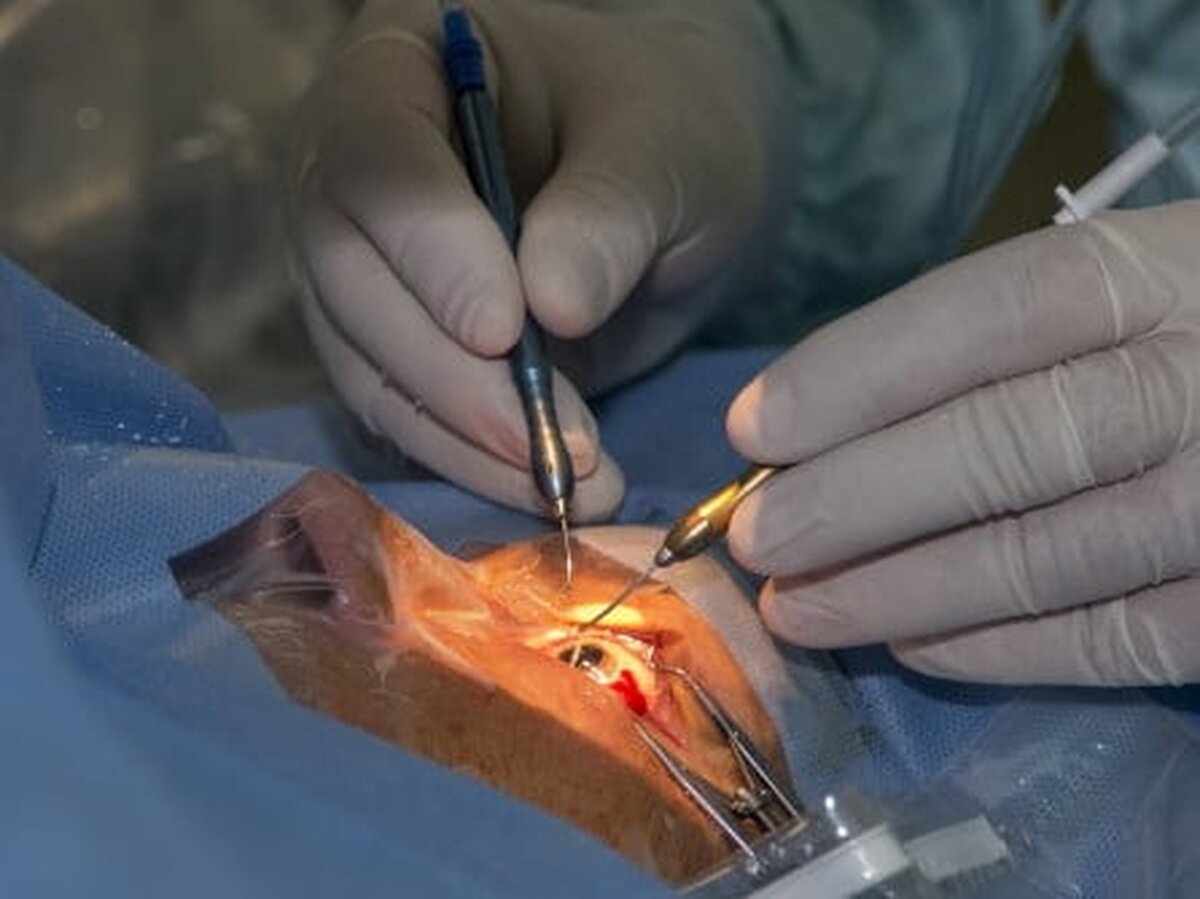 Medicii de la Clinica de Oftalmologie a Spitalului Sf Spiridon din Iaşi au efectuat două transplanturi de cornee