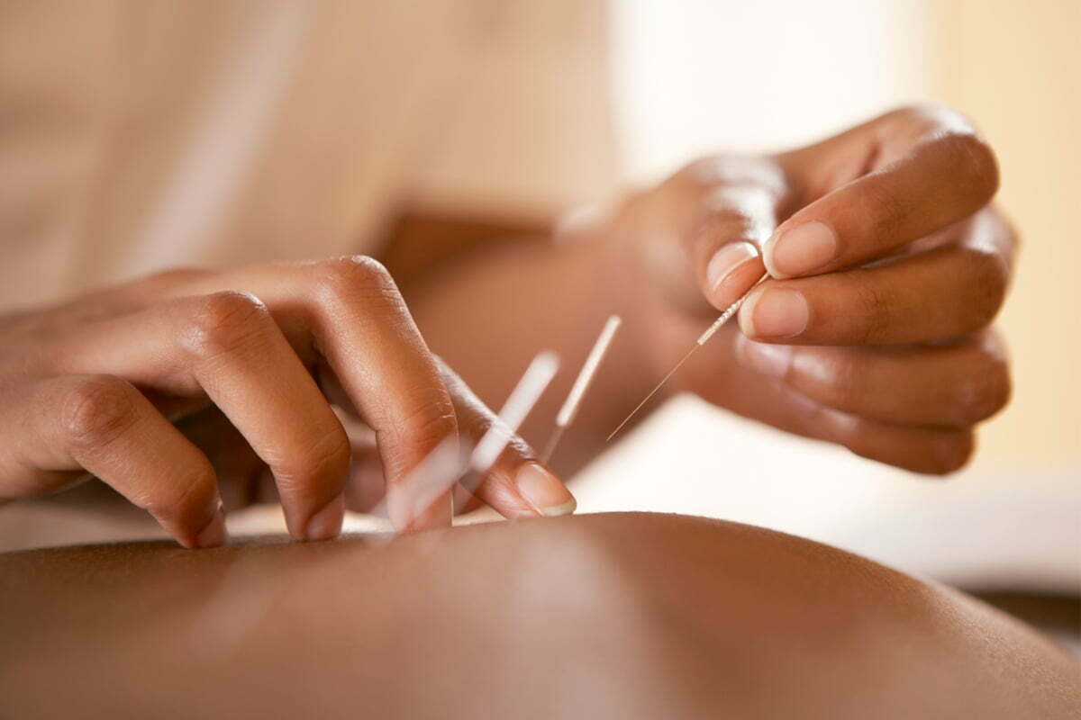 Cabinetul Acupunctură București oferă tratament pentru combaterea sindromului de tunel carpian