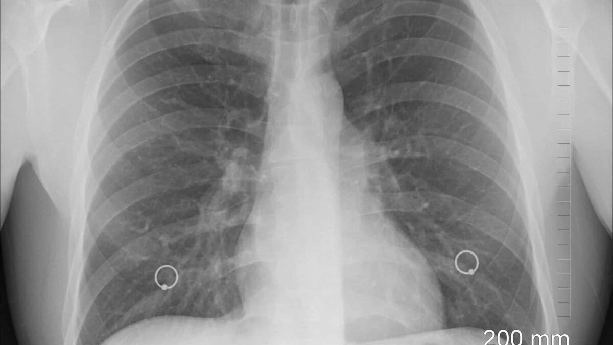 Sibiu: De Ziua Mondială a BPOC, peste 300 de pacienţi şi-au testat gratis sănătatea plămânilor diagnosis 1476620 1920
