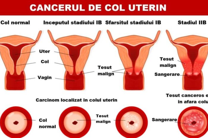 stadializare cancer de col uterin