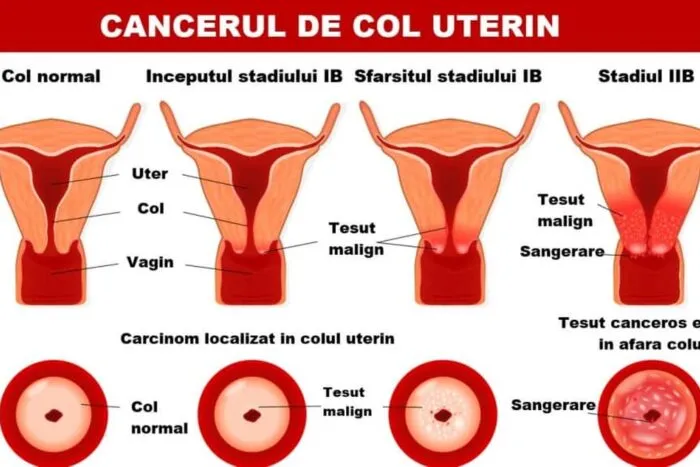 stadializare-cancer-de-col-uterin