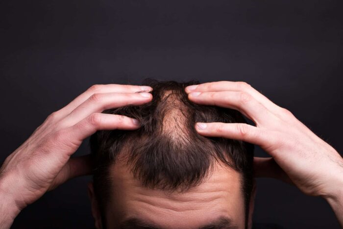 Cel mai eficient tratament împotriva alopeciei la femei și bărbați men with bald head black wall close up