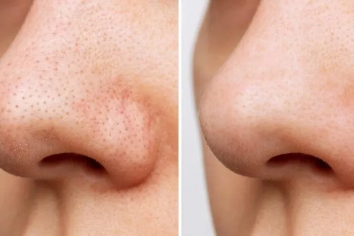 Pore-Trestment-Before-After-Stock-Photo.jpg