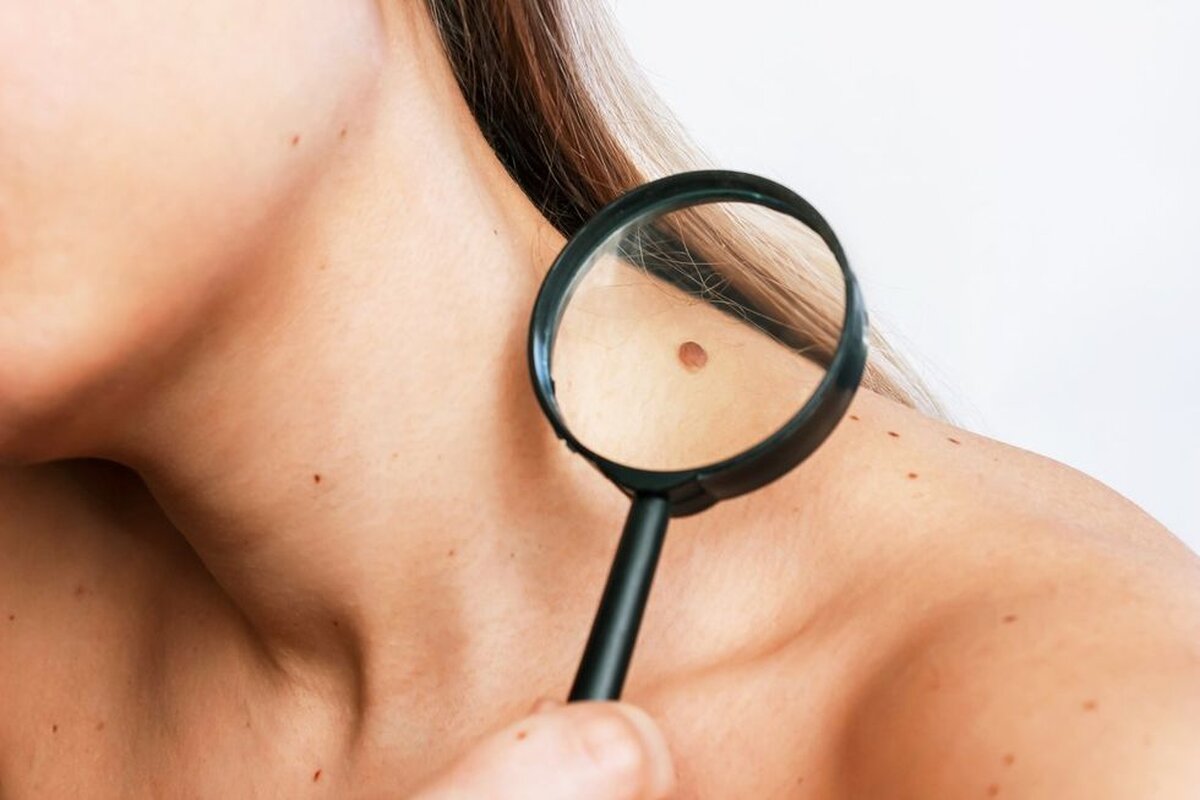 Melanomul 101, factori de risc, diagnostic, etape și tratament