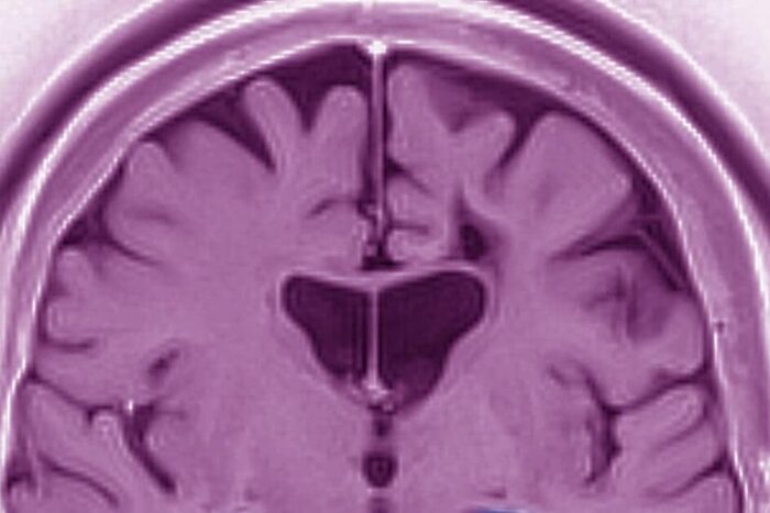 03alzheimers facebookJumbo