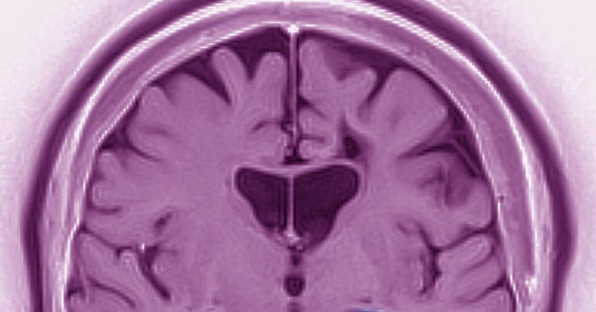 Studiul Eli Lilly:  donanemab, medicamentul Alzheimer poate încetini progresul bolii