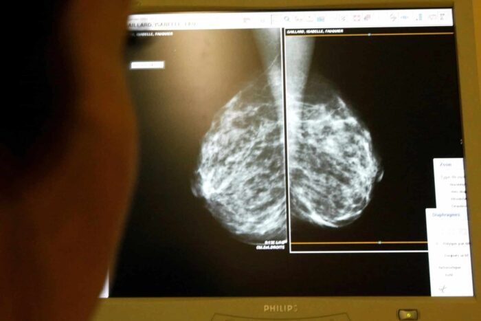 2023-05-08T215030Z_1313974488_RC2KU0AT8T73_RTRMADP_3_HEALTH-USA-BREAST-CANCER-1683658224.jpg