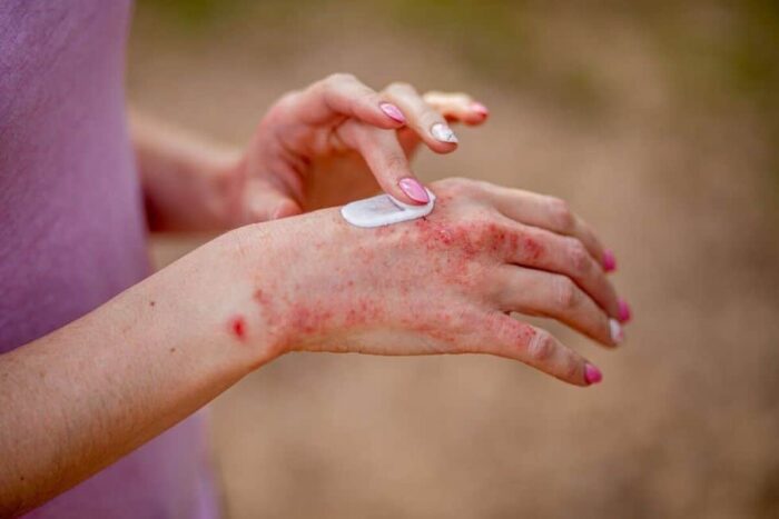 Cum va afecteaza psoriazisul bunastarea generala