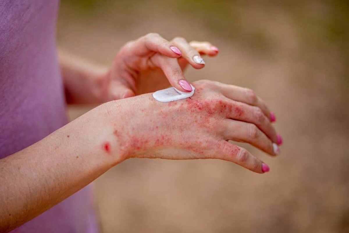 Cum vă afectează psoriazisul bunăstarea generală?