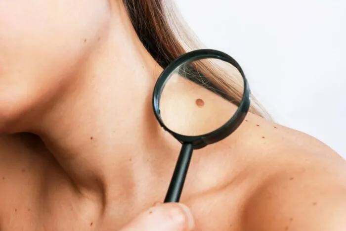 Melanomul-101-—-Factori-de-risc-diagnostic-etape-si-tratament.jpg