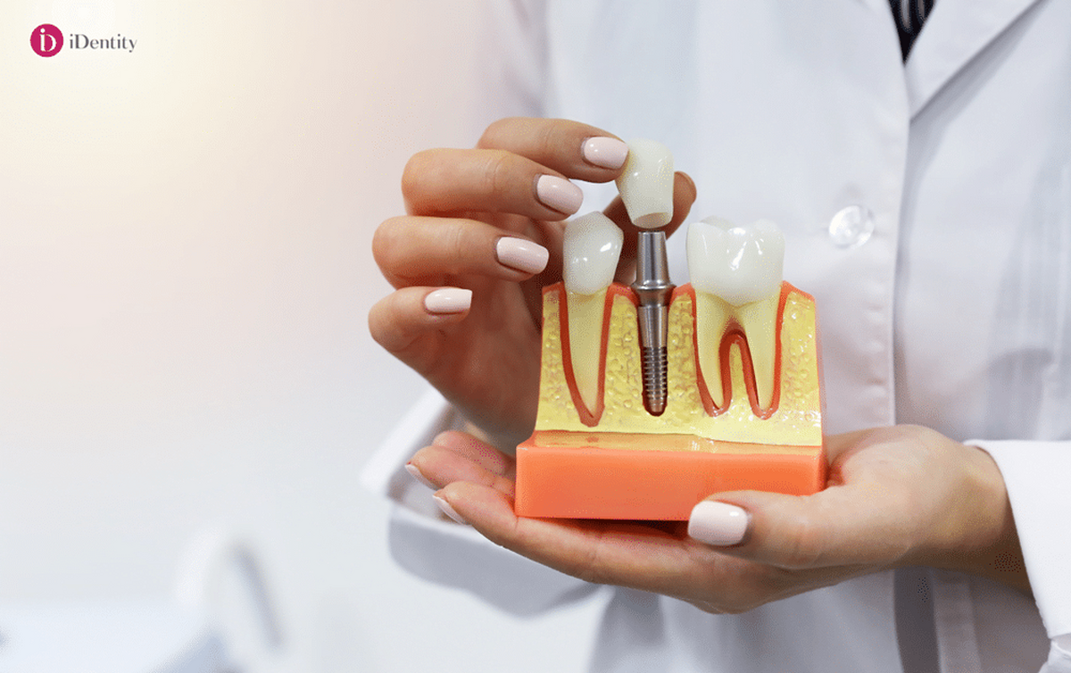 Cinci beneficii ale implanturilor dentare, dezvăluite de iDentity®️ Clinic. De ce să apelezi la această soluţie de restaurare a zâmbetului?
