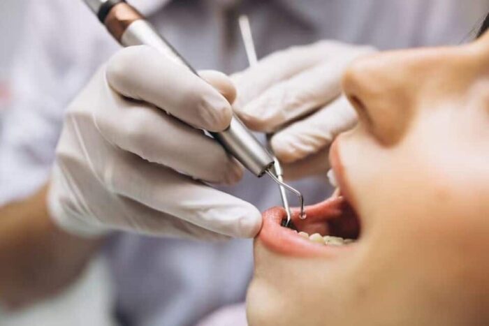 carii dentare