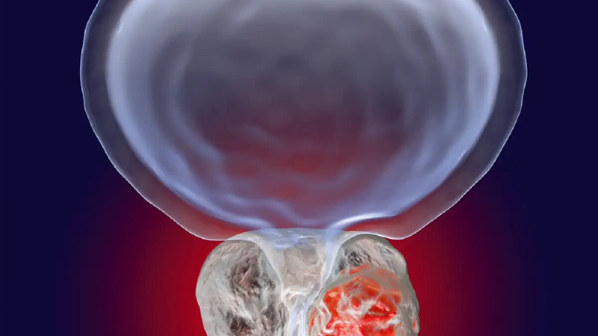 Orice bărbat trecut de 50 de ani, ar trebui să verifice o anumită boală cancer prostata sanador