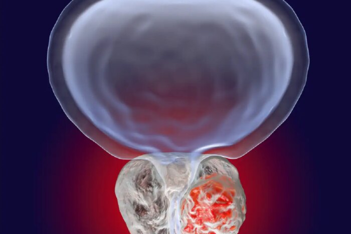 cancer prostata sanador