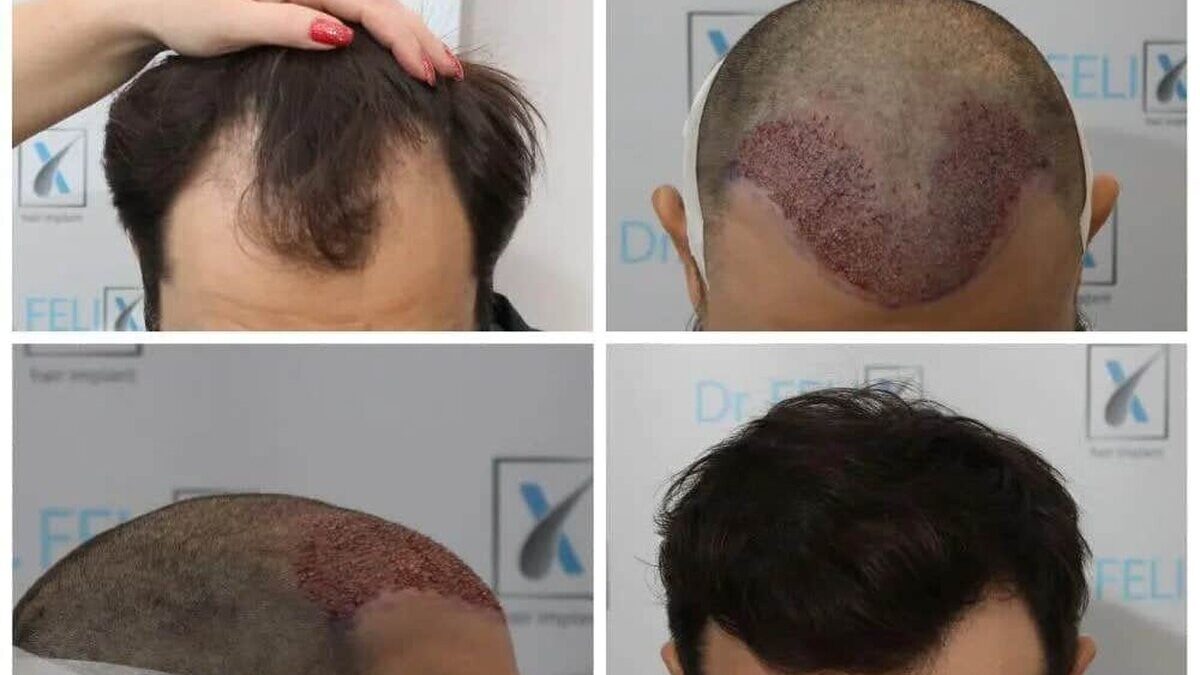 implant-par-dr-felix