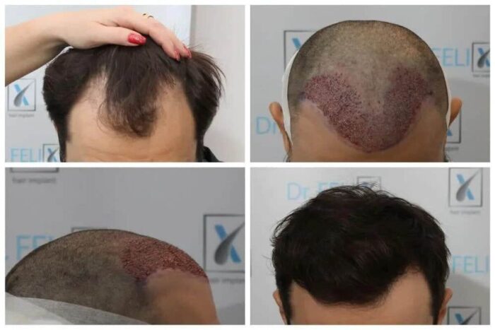 implant-par-dr-felix