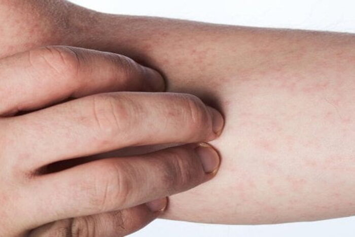 Simptome rujeola Semnul Koplik este caracteristic pentru rujeola pojar Cum