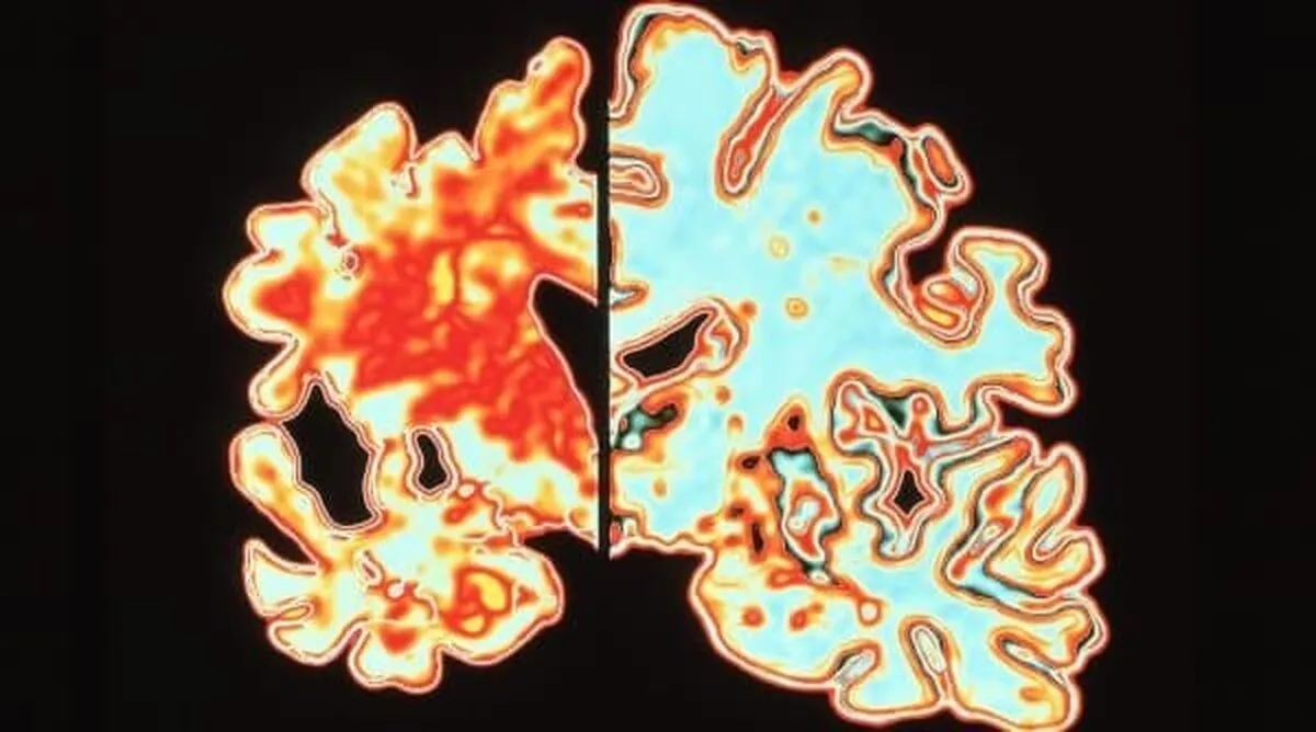 Un-tratament-nou-pentru-Alzheimer-cu-ultrasunete-prezinta-rezultate-uluitoare.jpg