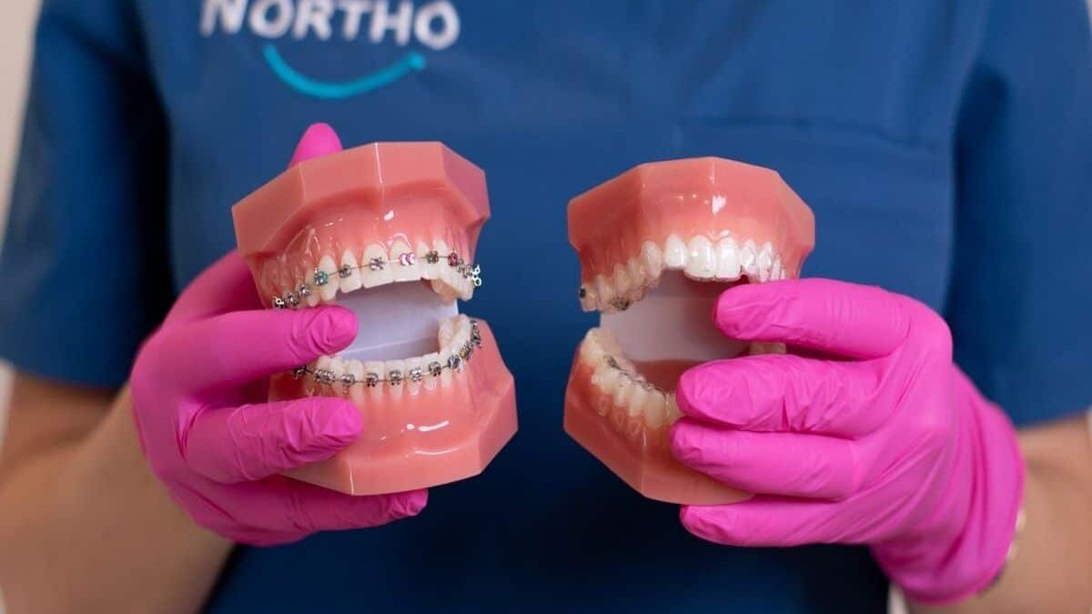 aparat dentar invizibil