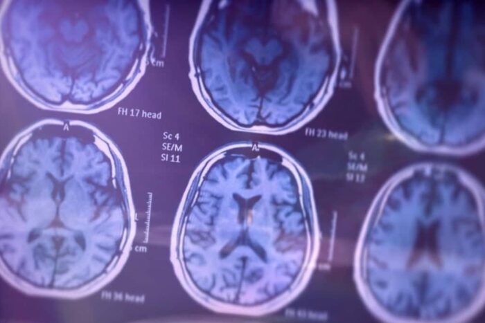 boala alzheimer diagnosticata din timp analize sange studiu 903827