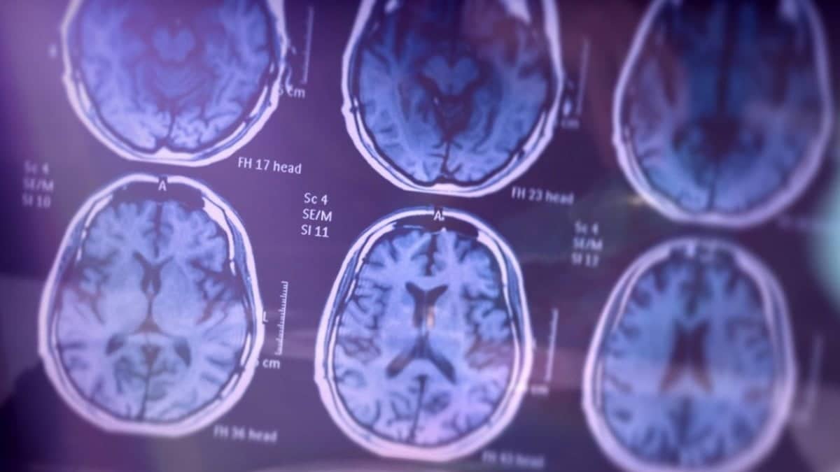 Boala Alzheimer ar putea fi diagnosticată din timp prin analize de sânge, arată ultimele descoperiri ale cercetătorilor japonezi