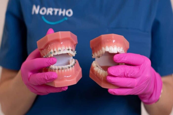 aparat dentar invizibil