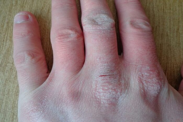 traieste cu dermatita atopica-modificat