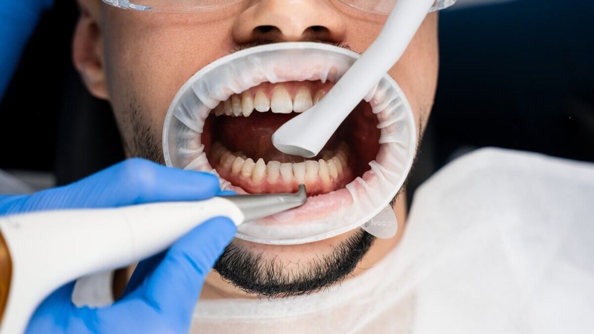 Dentist,Removes,Plaque,From,Teeth,With,Airflow,Equipment.,Dental,Hygiene