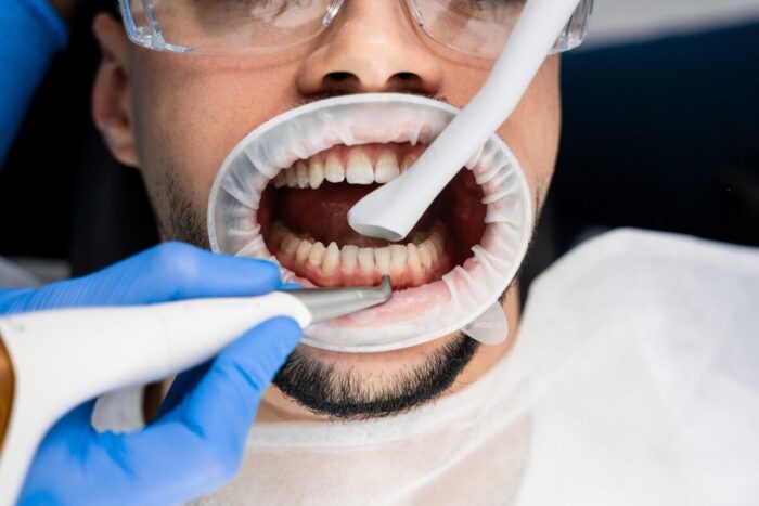 Dentist,Removes,Plaque,From,Teeth,With,Airflow,Equipment.,Dental,Hygiene
