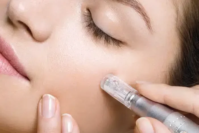 Microneedling.webp.webp