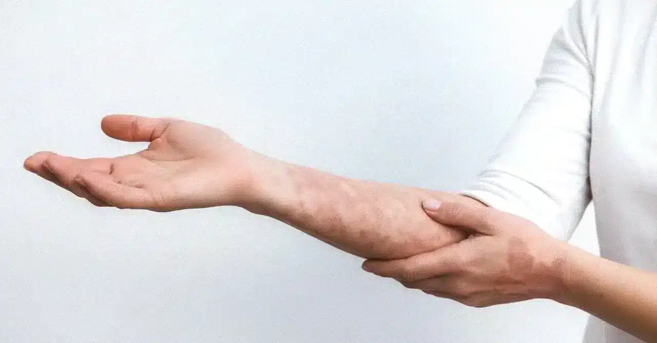 Descoperirea unui nou mecanism în psoriazis revoluționează înțelegerea bolii