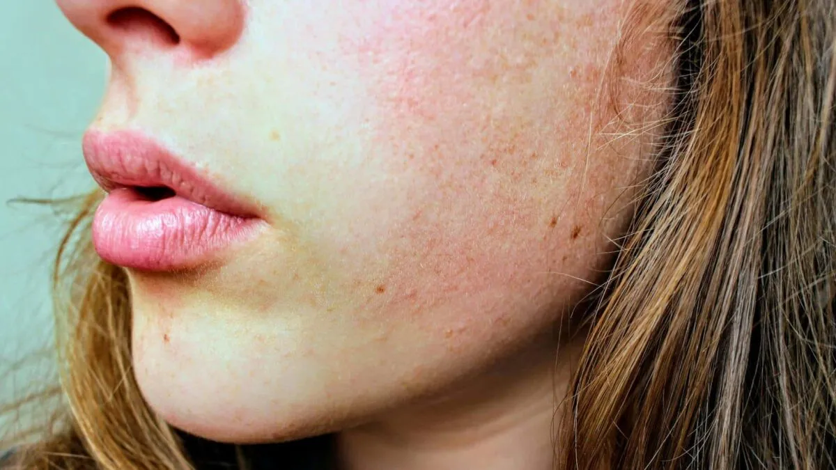 dermatita-atopica-semnele-pe-care-le-ignori-si-rutina-care-iti-salveaza-pielea