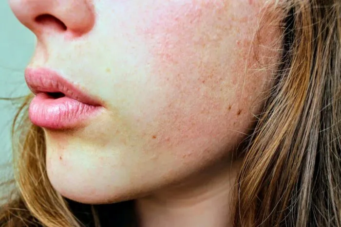 dermatita-atopica-semnele-pe-care-le-ignori-si-rutina-care-iti-salveaza-pielea