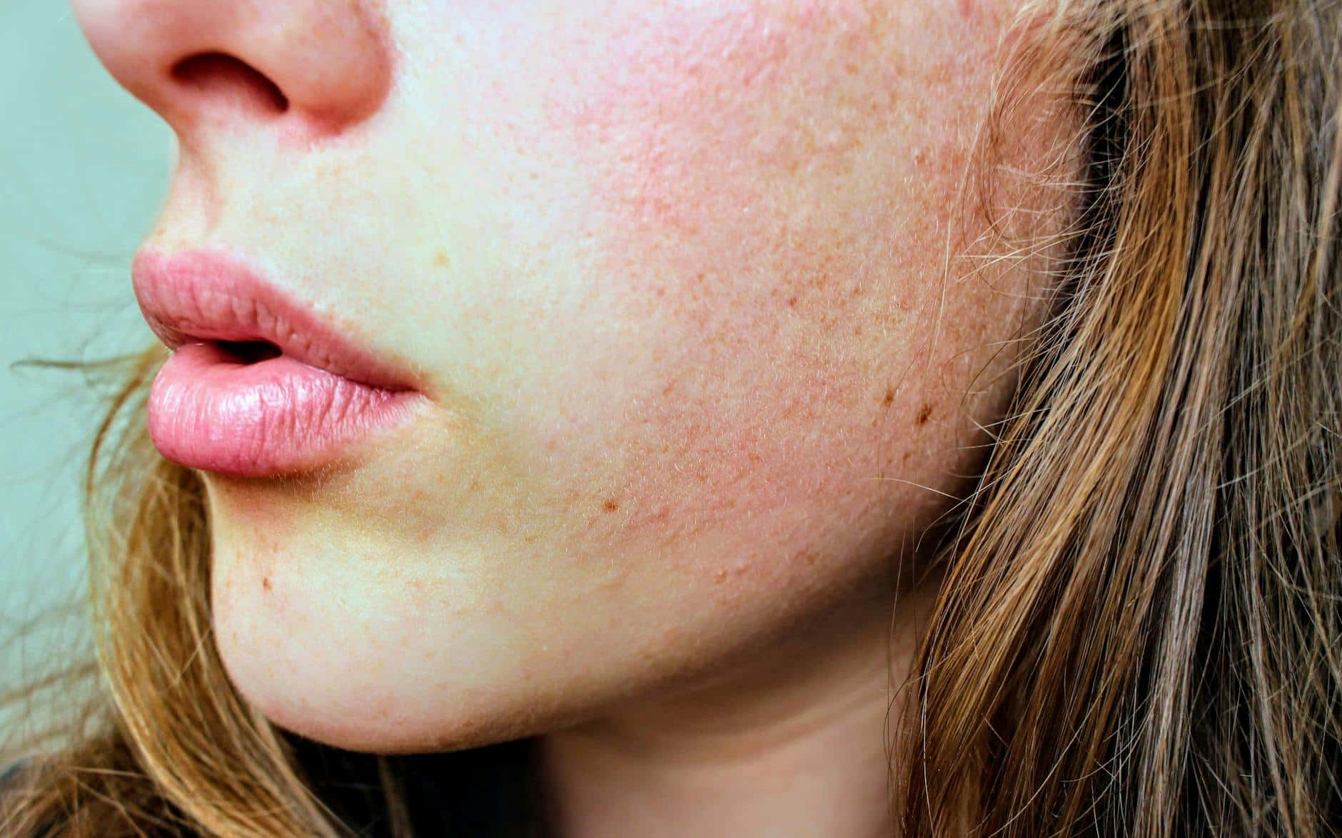 Dermatita atopică: Semnele pe care le ignori și rutina care îți salvează pielea