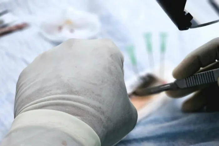 Spania: Primul transplant facial de la un donator cu moarte asistată