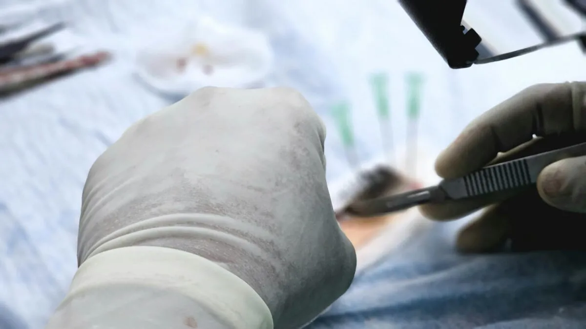 Spania: Primul transplant facial de la un donator cu moarte asistată