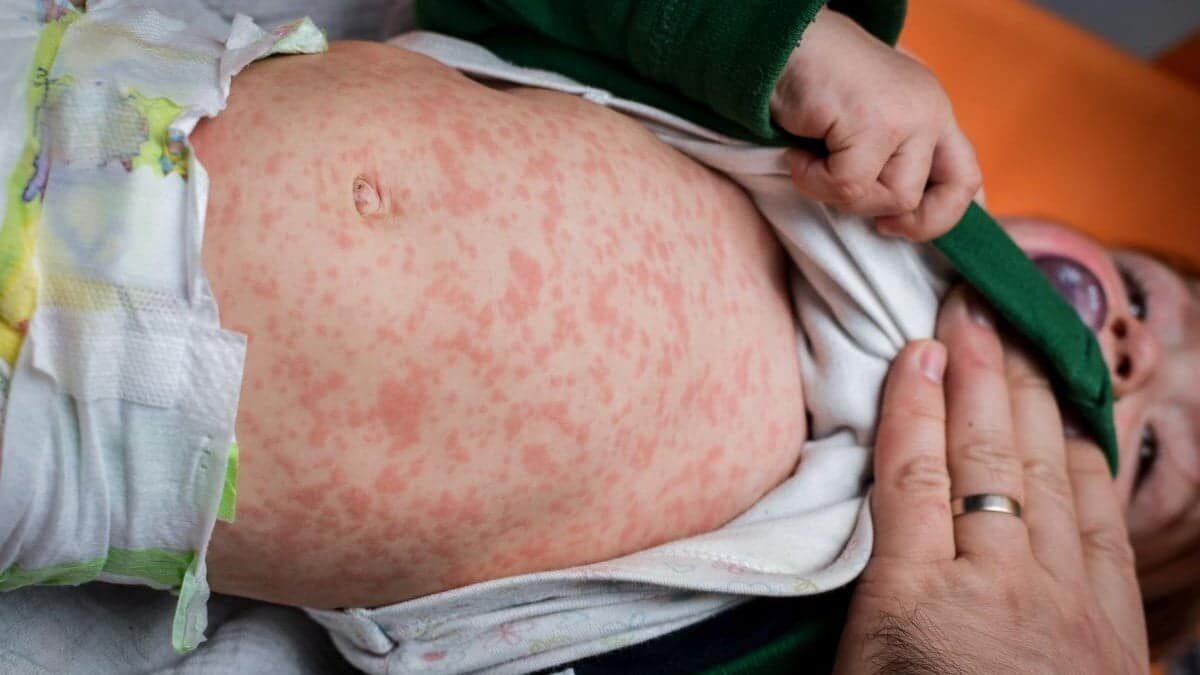 Cazurile de rujeolă în România depășesc restul Europei la o diferență drastică