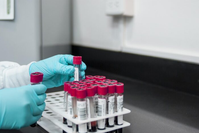 Un nou test de sange ar putea anticipa recidiva cancerului testicular un nou test de sange ar putea anticipa recidiva cancerului testicular 1772619360