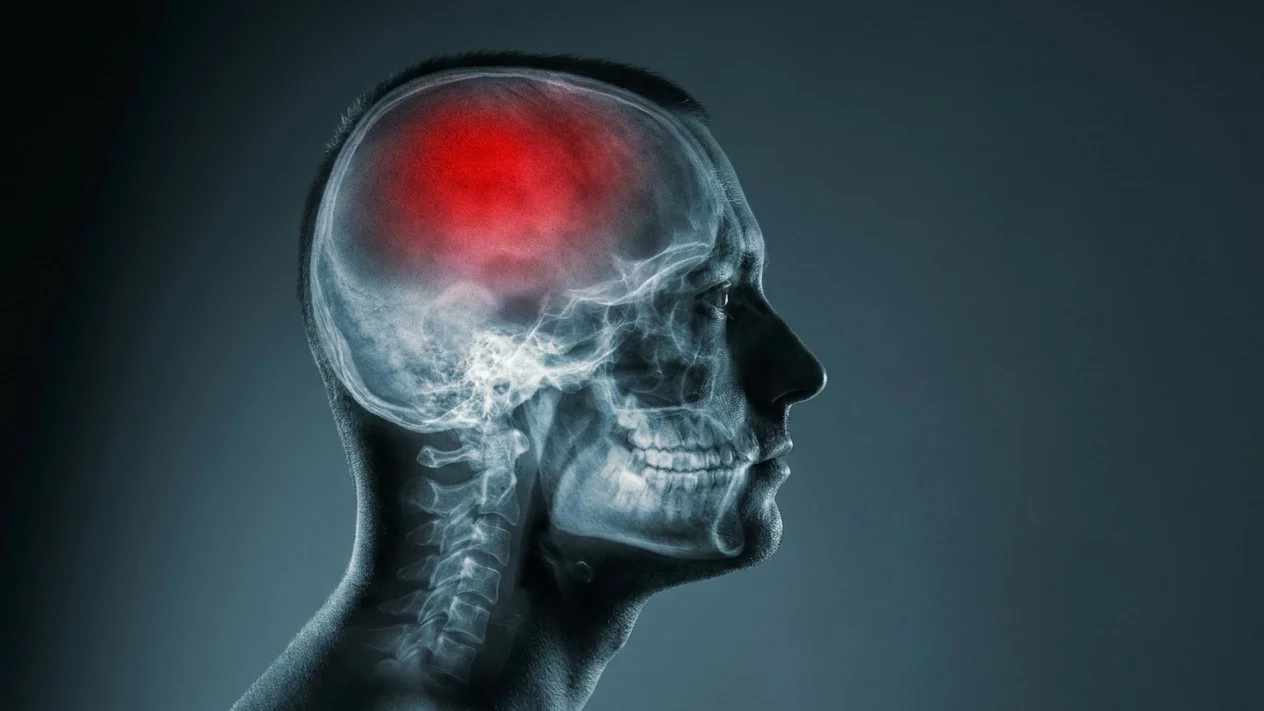 Lărgirea arterelor cerebrale provoacă AVC lacunar. Datele studiului clinic pe 229 de pacienți