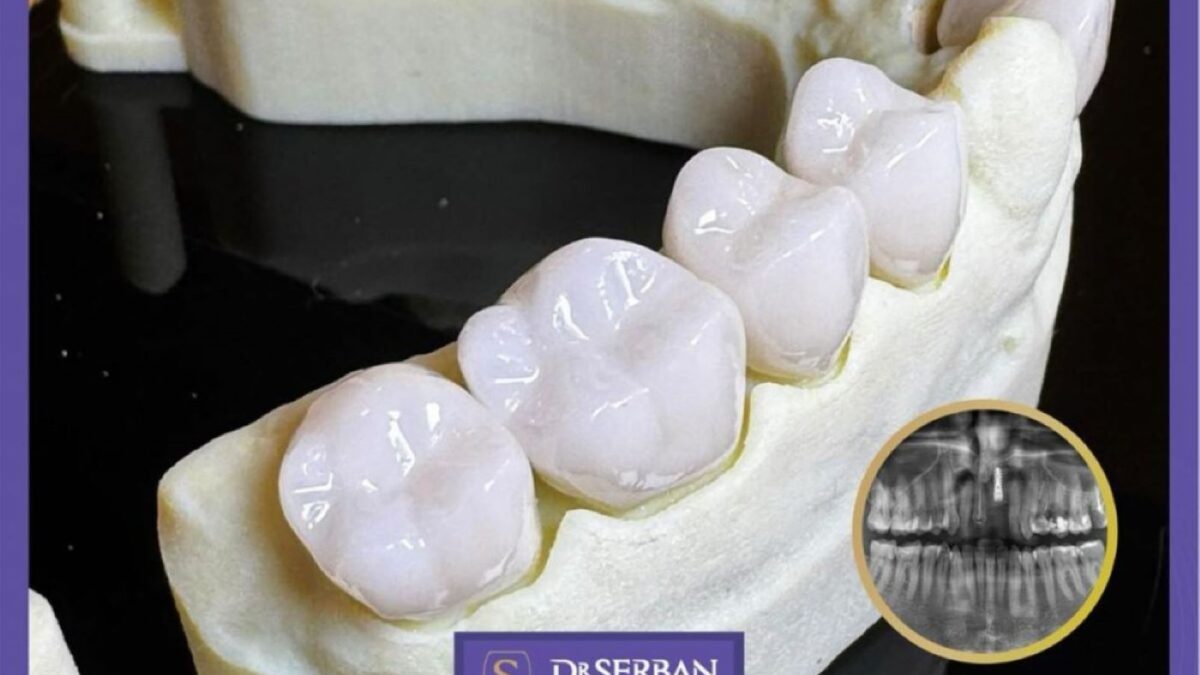 corornana dentara zirconiu drsrban 1 1