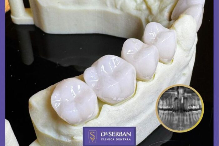 Coroane dentare realizate la clinica Dr. Șerban din București - cum te ajută? corornana dentara zirconiu drsrban 1 1