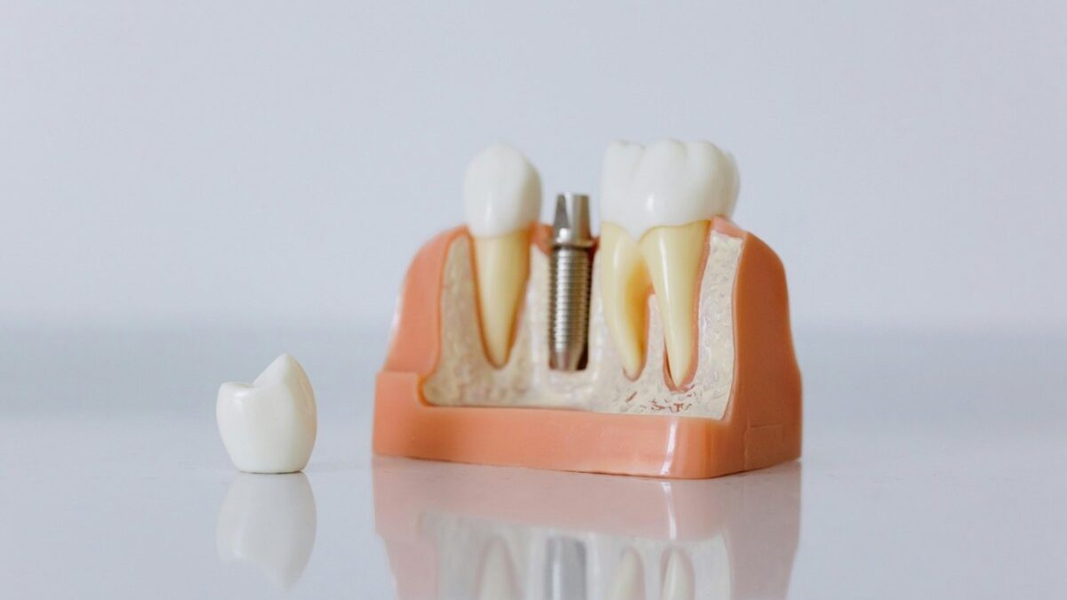 Implant dentar preț: cum se formează costul și de ce nu există o sumă standard Implant dentar pret cum se formeaza costul si de ce nu exista o suma standard