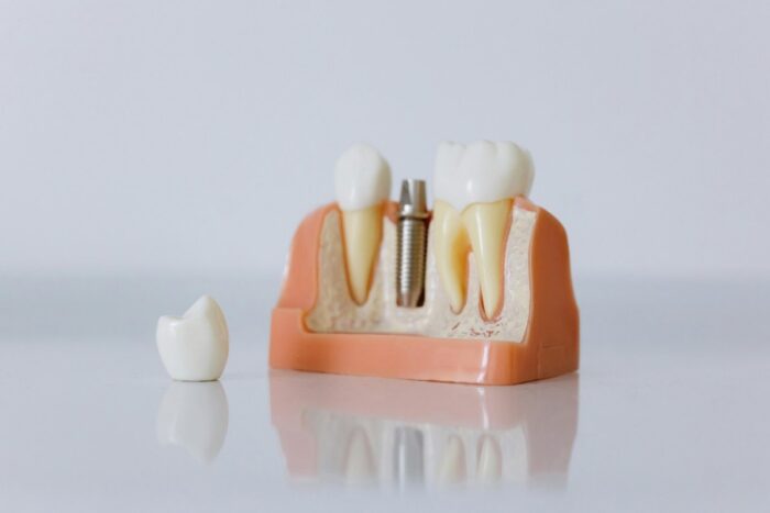 Implant dentar preț: cum se formează costul și de ce nu există o sumă standard Implant dentar pret cum se formeaza costul si de ce nu exista o suma standard