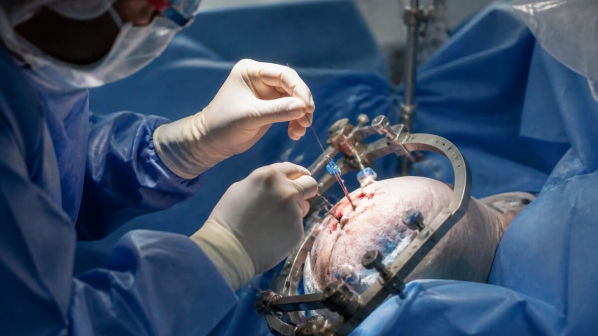 Paradromics a anunțat primul implant cerebral la om. Ce schimbă pasul făcut de rivala Neuralink Paradromics a anunțat primul implant cerebral la om. Ce schimbă pasul făcut de rivala Neuralink