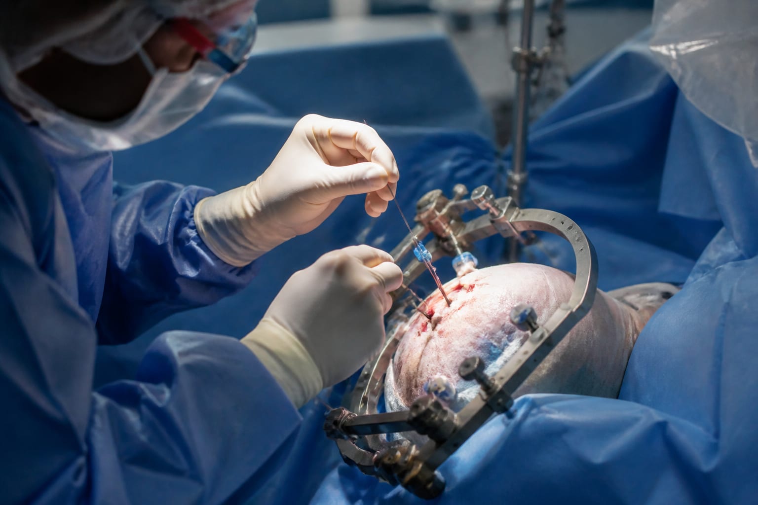 Paradromics a anunțat primul implant cerebral la om. Ce schimbă pasul făcut de rivala Neuralink