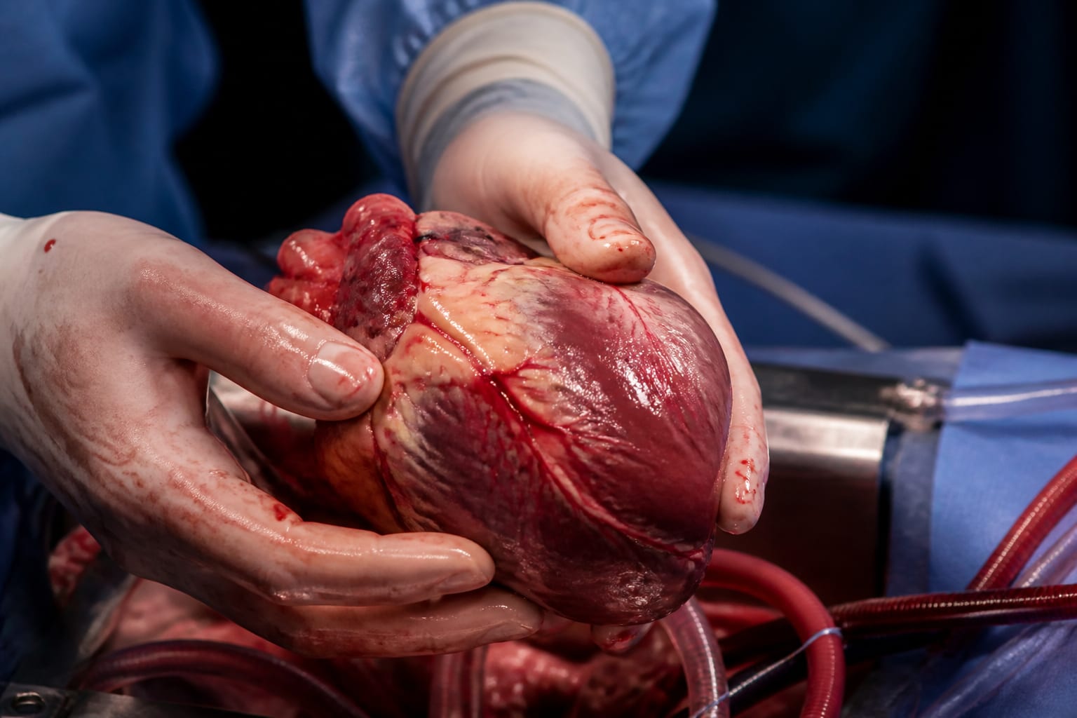 44 de ani, salvat prin primul transplant de inimă din istoria Institutului de Boli Cardiovasculare din Iași