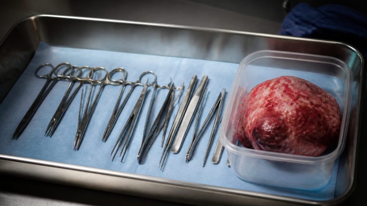 O tumoră retroperitoneală de 10 kilograme a fost extirpată la Spitalul Județean Sibiu