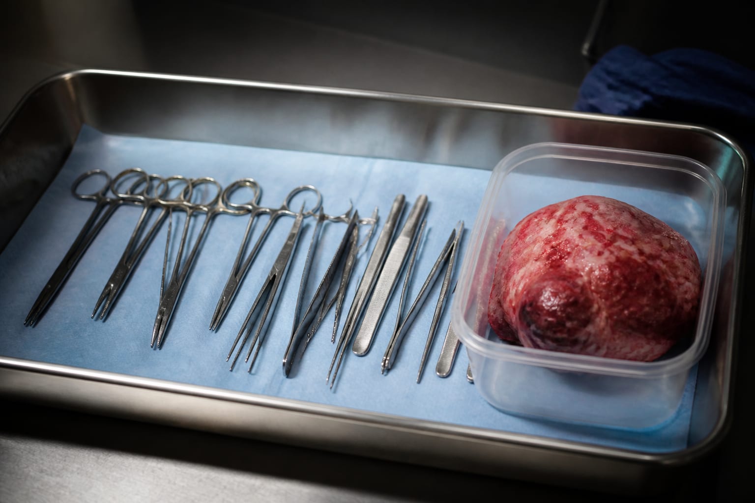 O tumoră retroperitoneală de 10 kilograme a fost extirpată la Spitalul Județean Sibiu