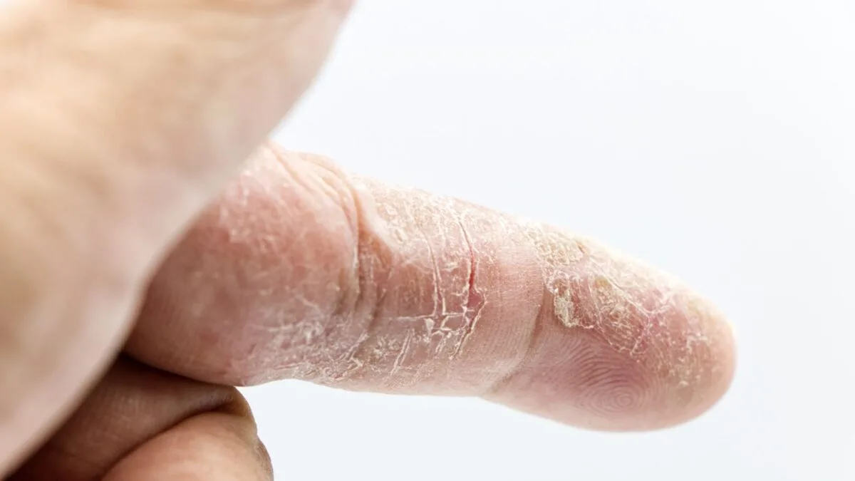 Degete afectate de psoriazis