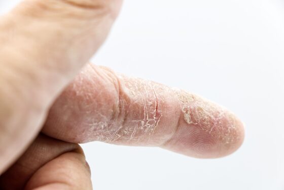 În psoriazis, emolientul poate calma pielea, dar omega-3 și aloe vera nu înlocuiesc tratamentul